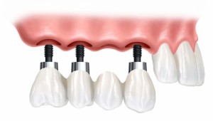 Screw retained implant restorations